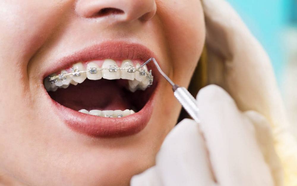 Етапи встановлення брекетів: як ставлять брекети на зуби