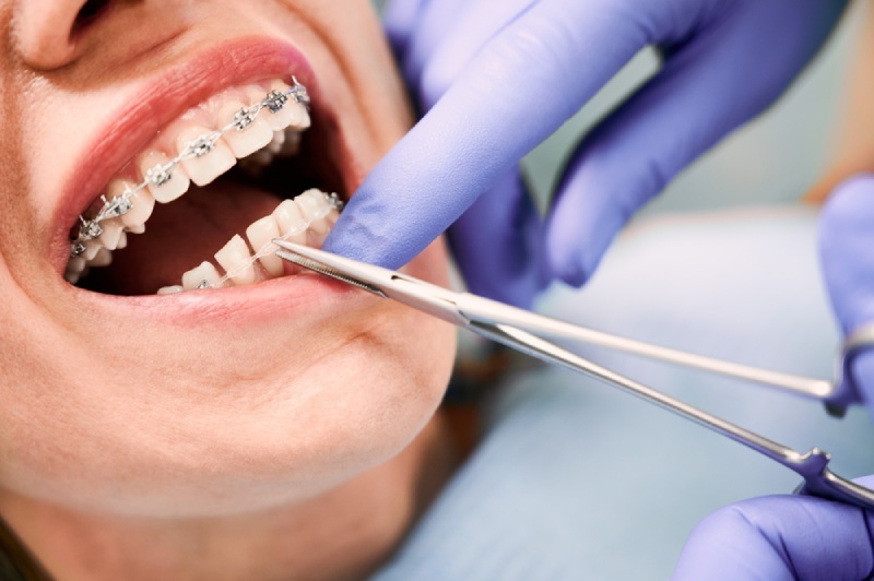 yak-vstanovluut-breketi Підготовка до встановлення брекетів: етапи підготовки